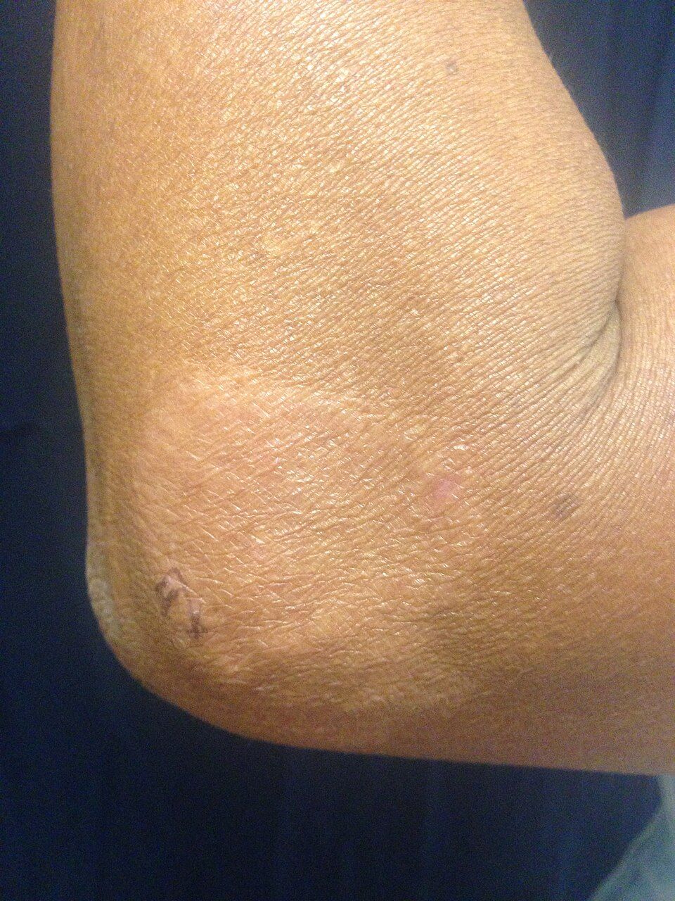 Hypopigmented anesthetic skin patch of paucibacillary (tuberculoid) leprosy