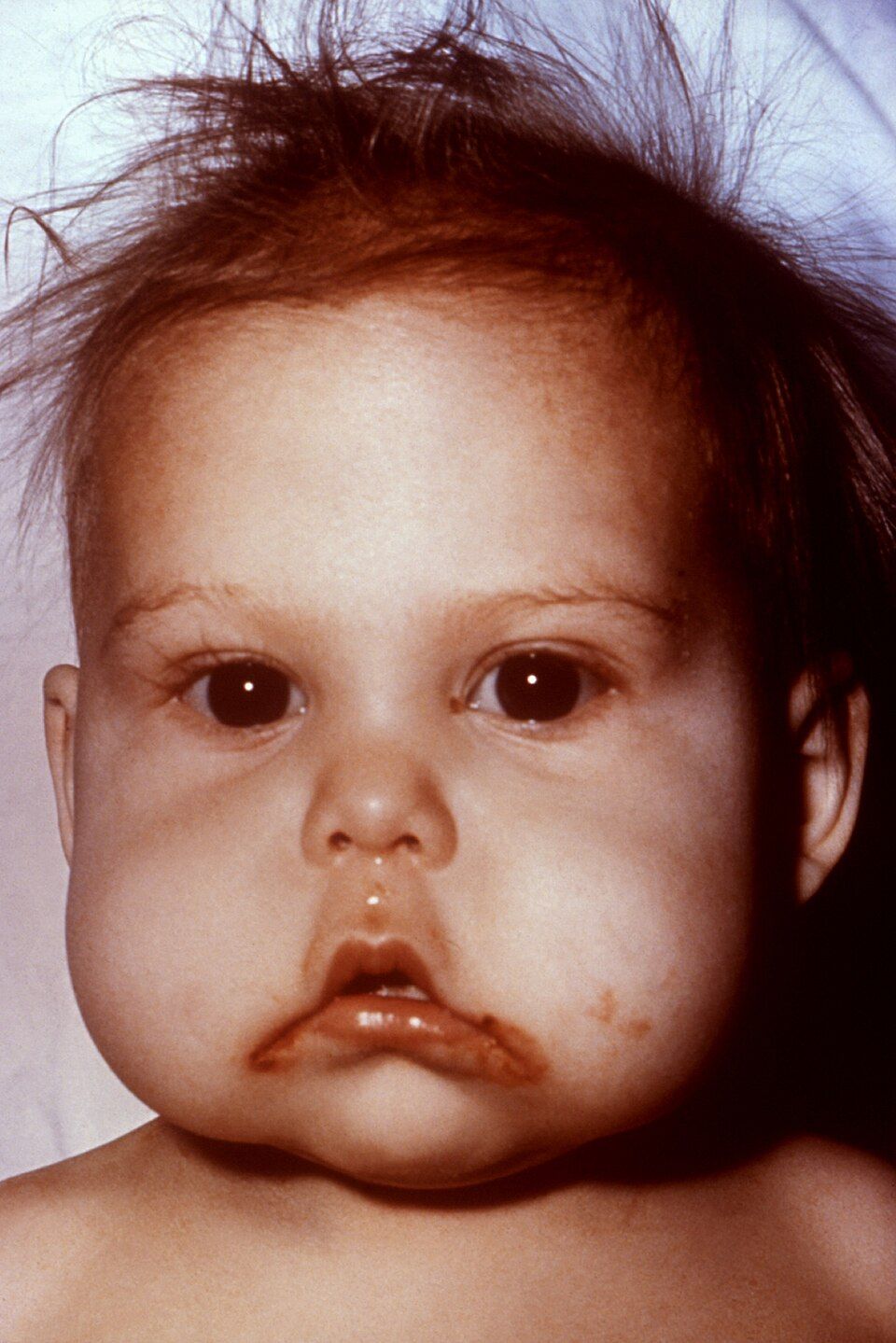 Facial appearance of a child with kwashiorkor showing sparse discolored hair