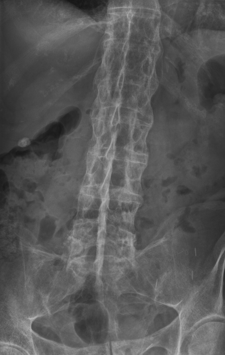 AP abdomen/spine radiograph showing a rigid bamboo spine with bridging syndesmophytes