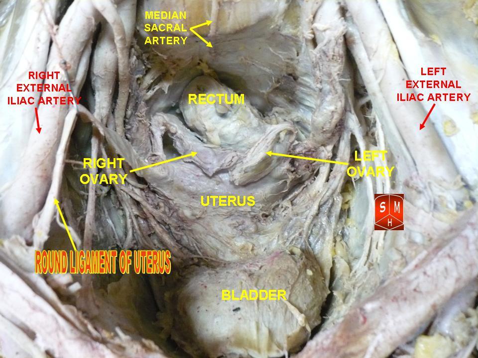 Cadaveric female pelvis with the round ligament of the uterus labelled