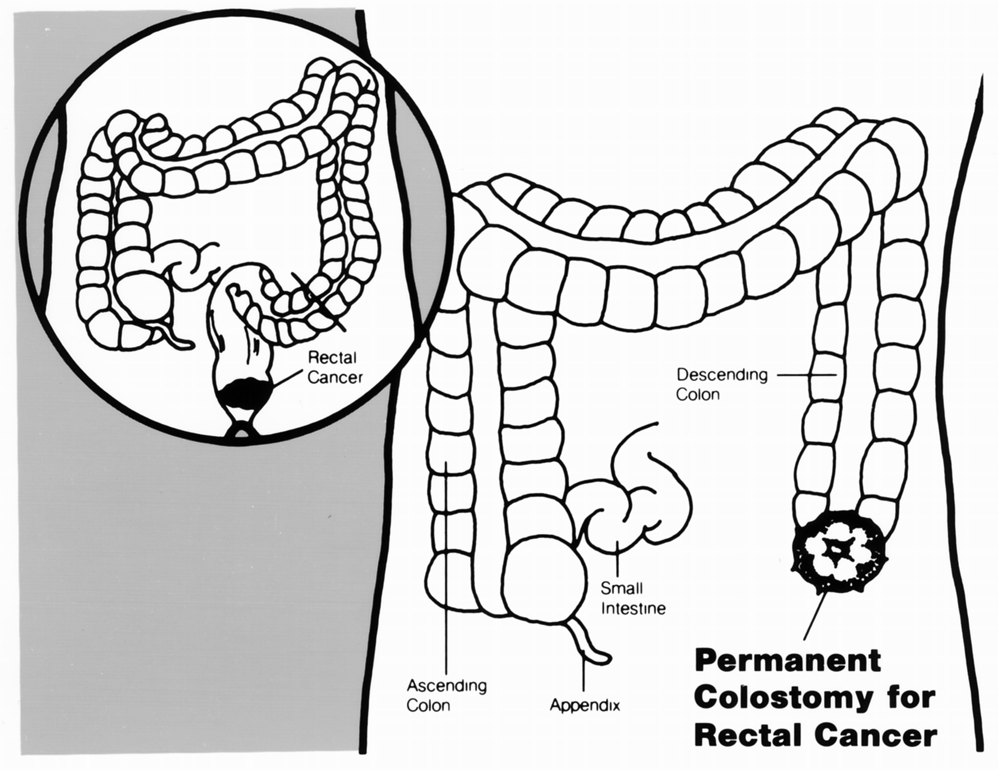 Diagram of a colostomy