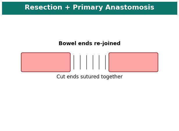 Bowel resection and primary anastomosis diagram