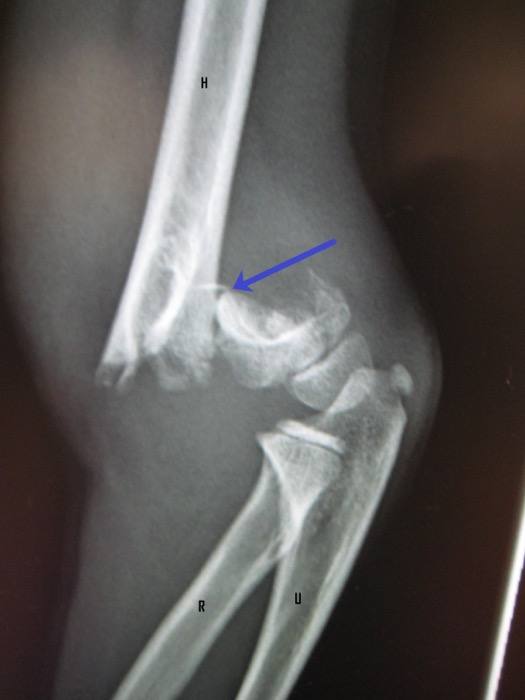 Paediatric elbow radiograph showing a supracondylar humeral fracture