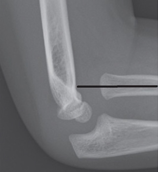 Elbow radiograph with an abnormal radiocapitellar line indicating dislocation