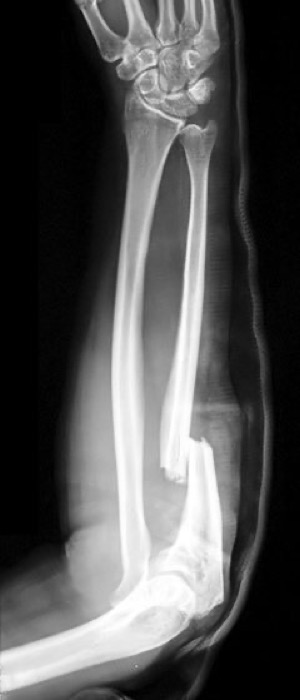 Forearm radiograph showing an ulnar fracture with radial head dislocation