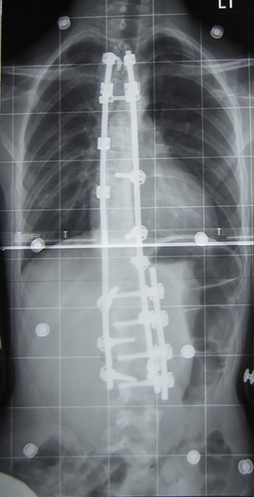Spine radiograph showing posterior instrumentation from previous fusion surgery