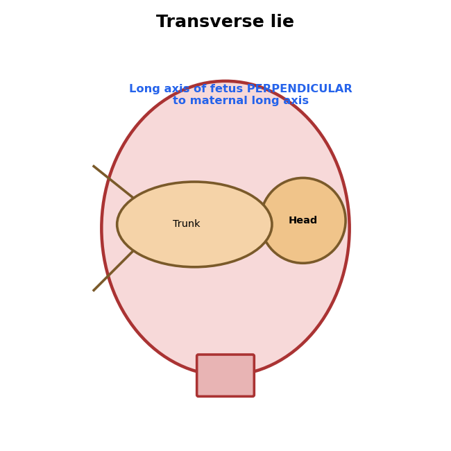 Diagram of transverse lie with the fetus lying across the uterus