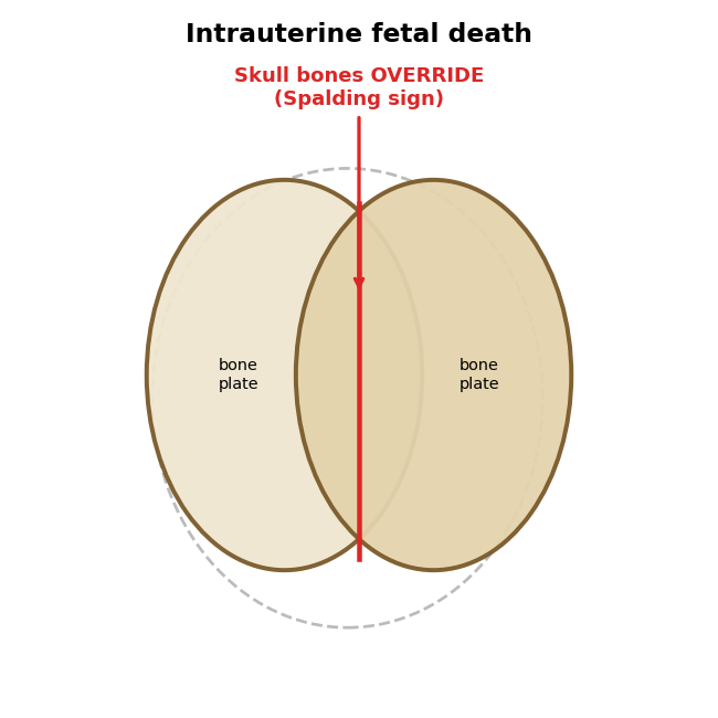 Diagram of overlapping fetal skull bones (Spalding sign) in intrauterine fetal death