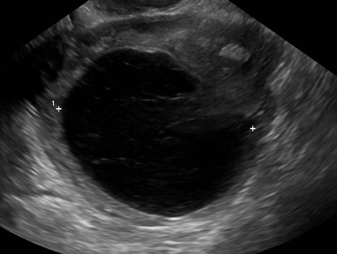 Ultrasound image of a small adnexal mass