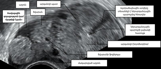Ultrasound of a tubal ectopic pregnancy (blob sign) in the adnexa