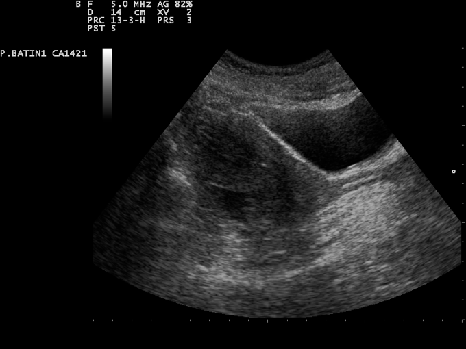 Pelvic ultrasound assessing the pouch of Douglas for free fluid