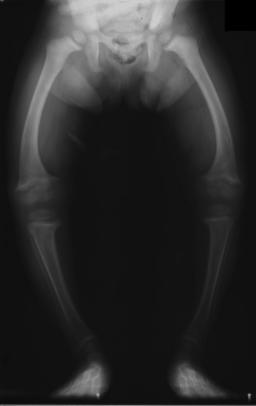 Radiograph showing bowing of the legs in rickets