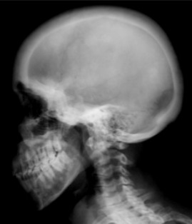 Ground-glass skull in renal osteodystrophy
