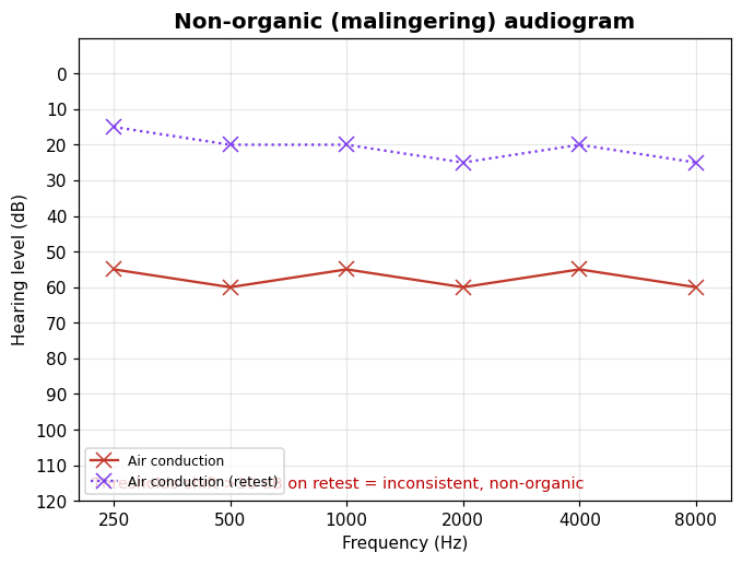 Audiogram showing inconsistent thresholds on retest