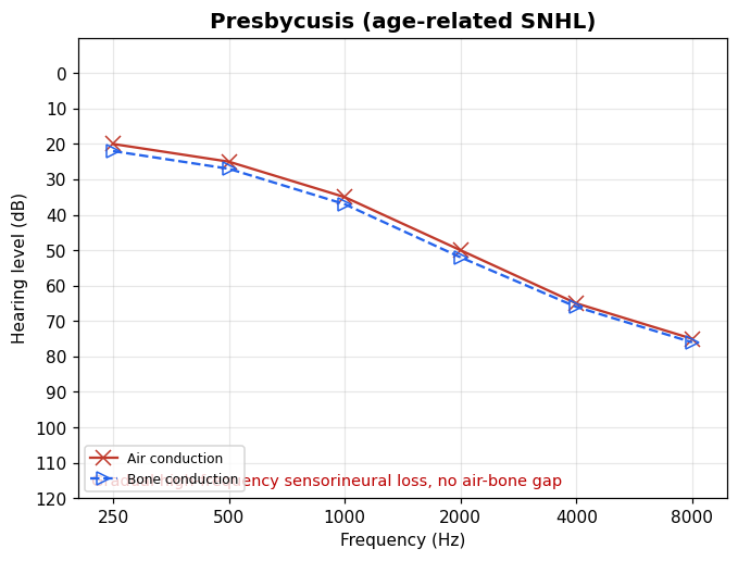 Down-sloping audiogram of presbycusis