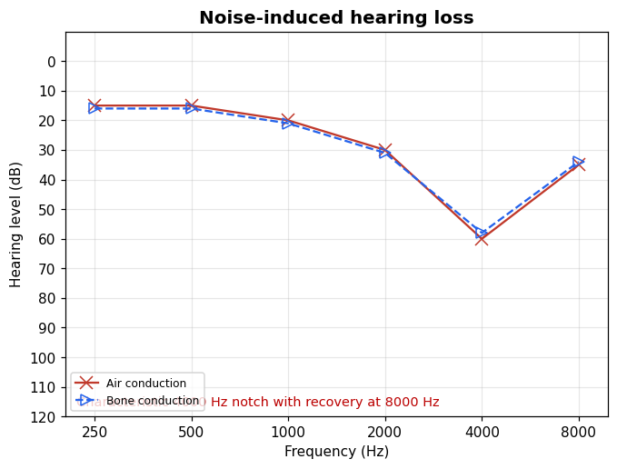 Audiogram with a 4000 Hz notch