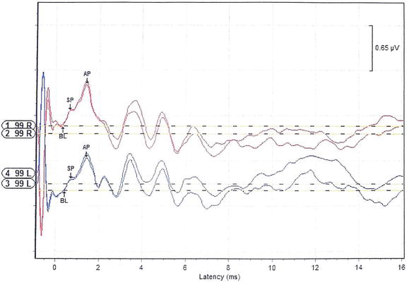 Auditory evoked-response waveform with latency in milliseconds
