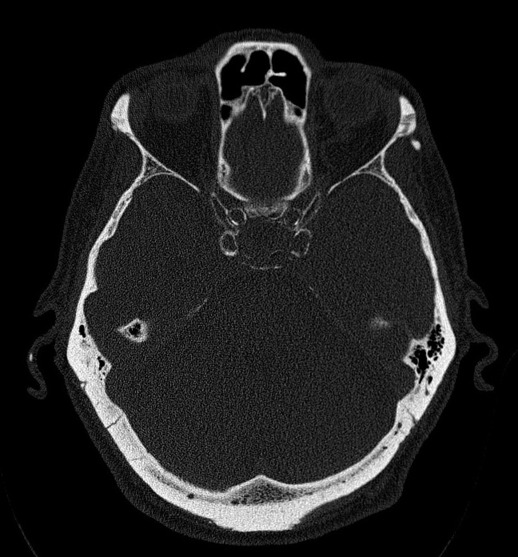 Axial CT of the temporal bone in bone window