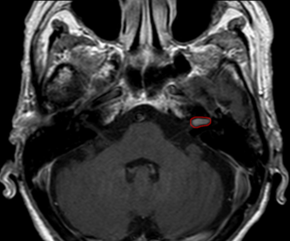 Gadolinium-enhanced axial MRI showing an enhancing intracanalicular vestibular schwannoma at the cerebellopontine angle