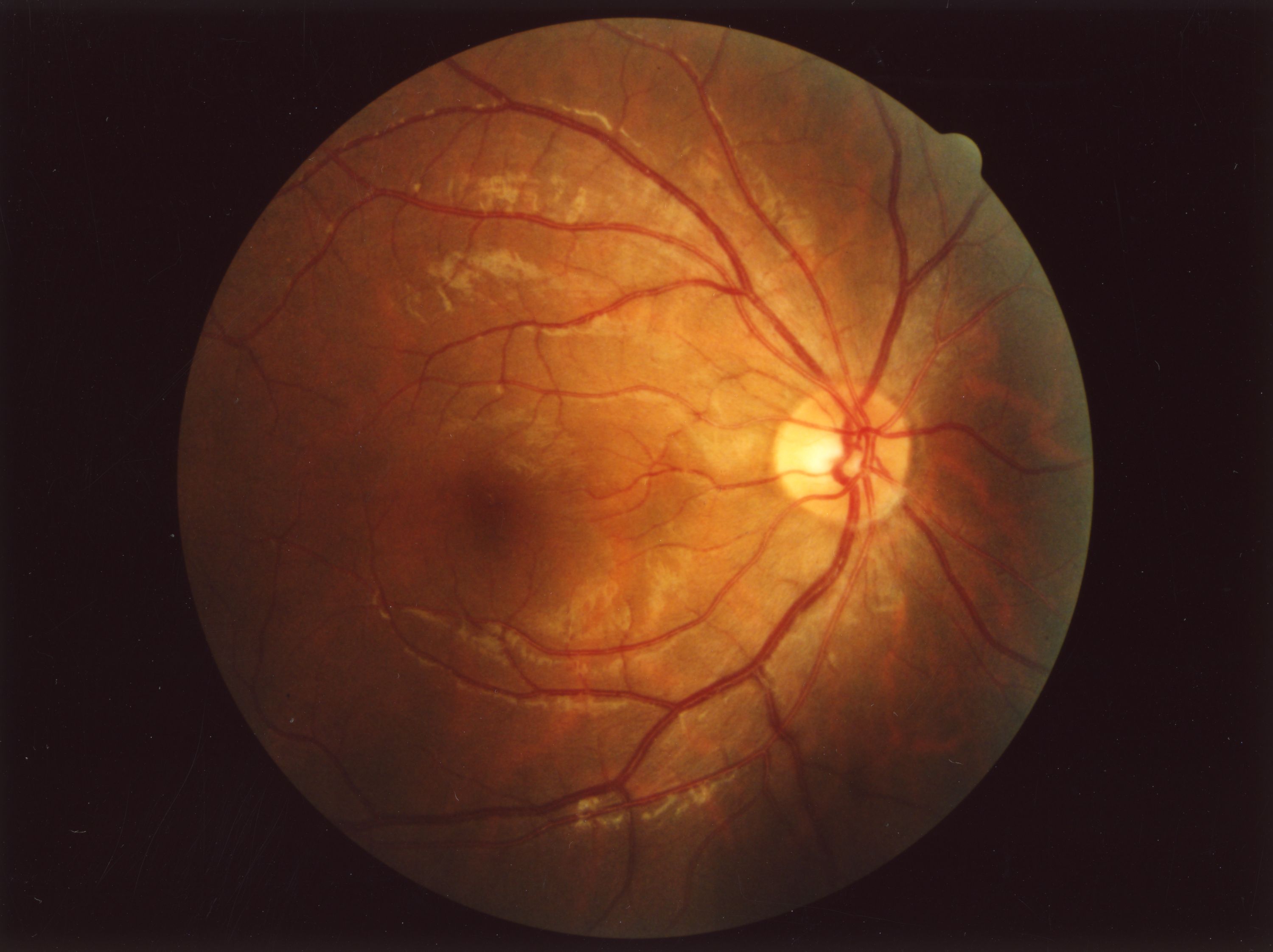 Fundus showing the optic disc