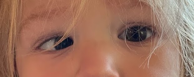 Child with esotropia (inward eye turn)