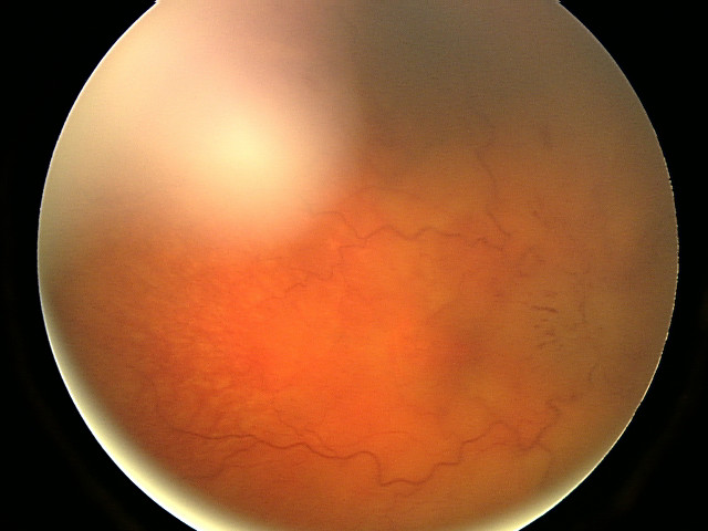 Swollen optic disc