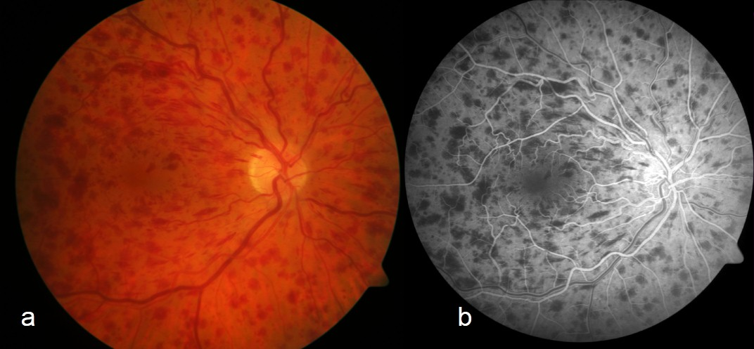 Fundus of central retinal vein occlusion