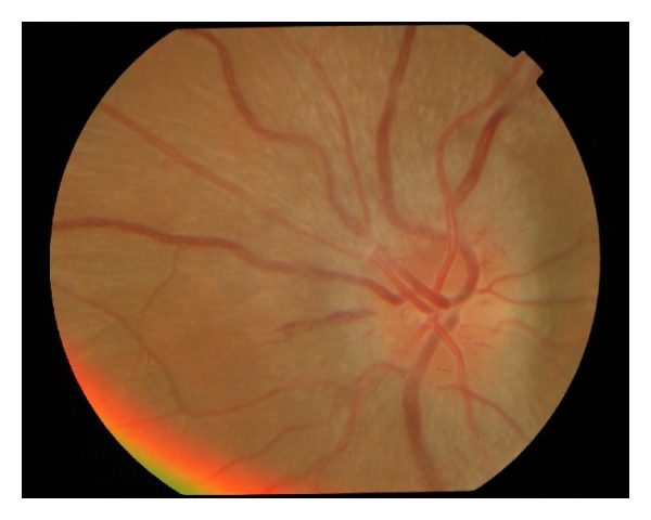 Fundus in optic neuritis