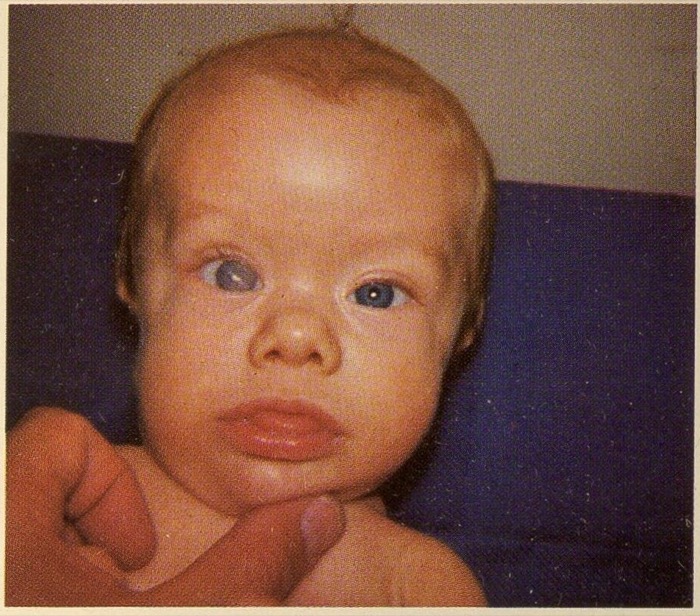 Autosomal dominant disorder