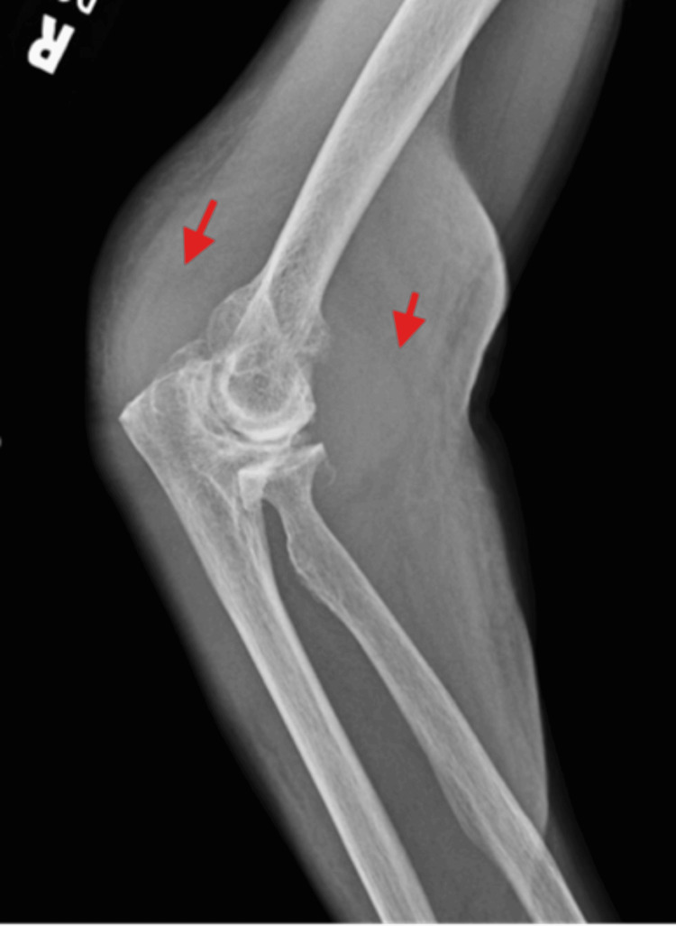 Haemophilia haemarthrosis swollen knee joint