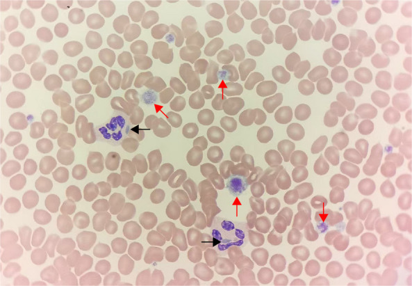 Bernard-Soulier giant platelets blood smear