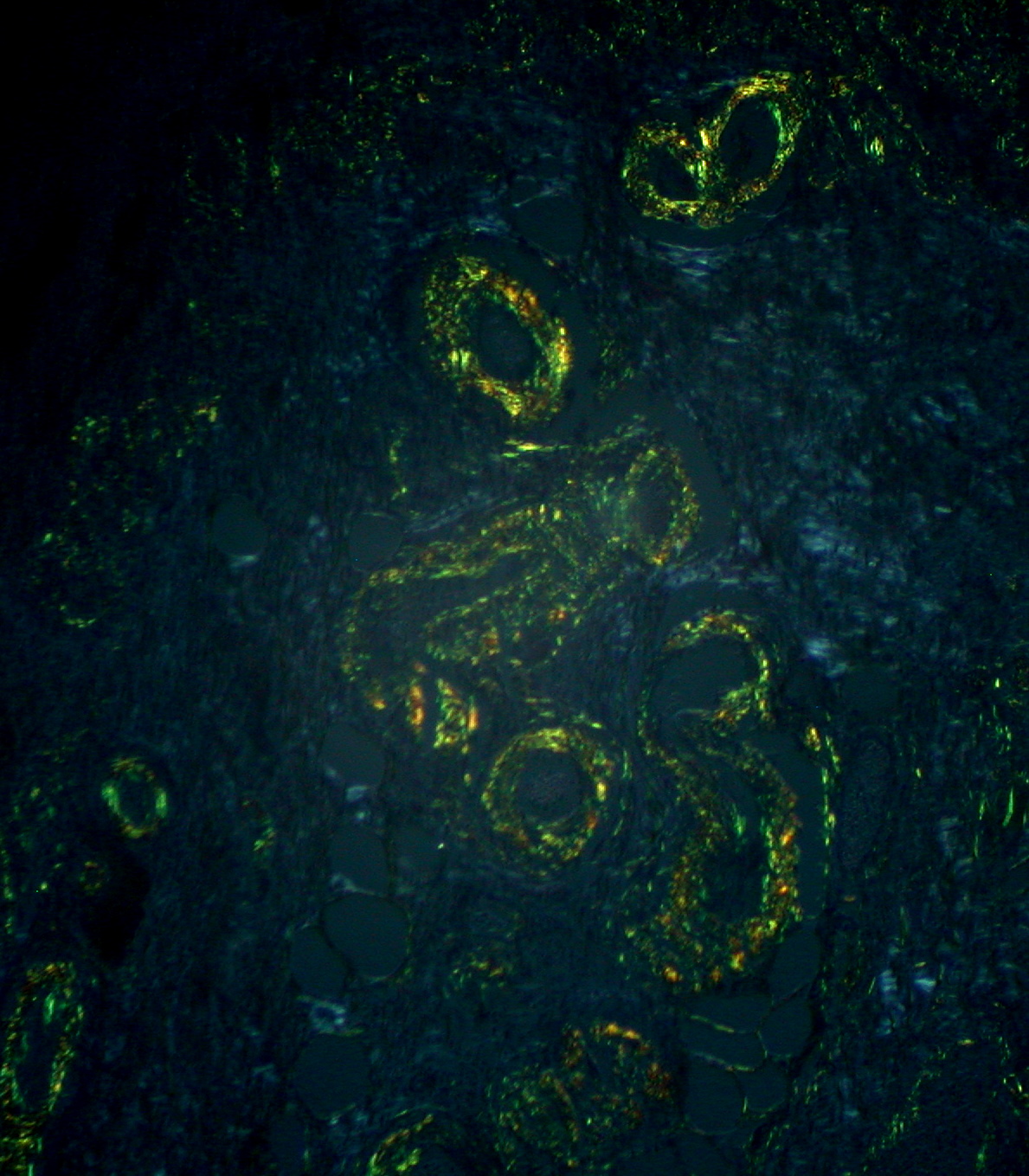 Congo red amyloid apple green birefringence