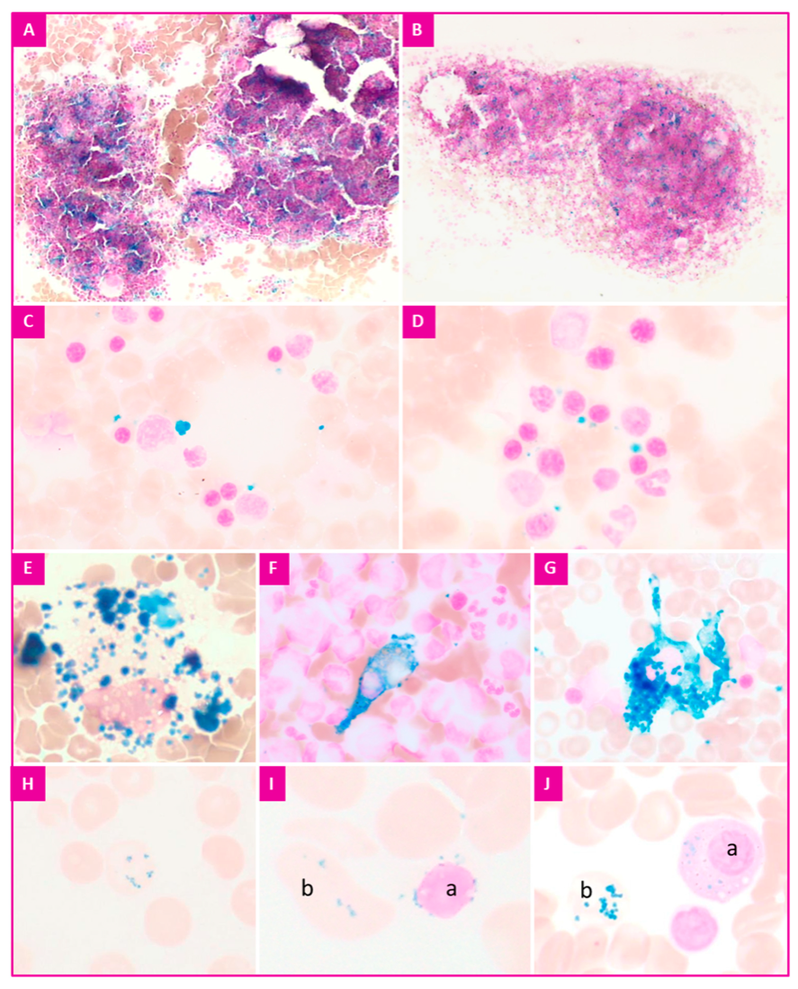 Perls Prussian blue stain haemosiderin iron in tissue