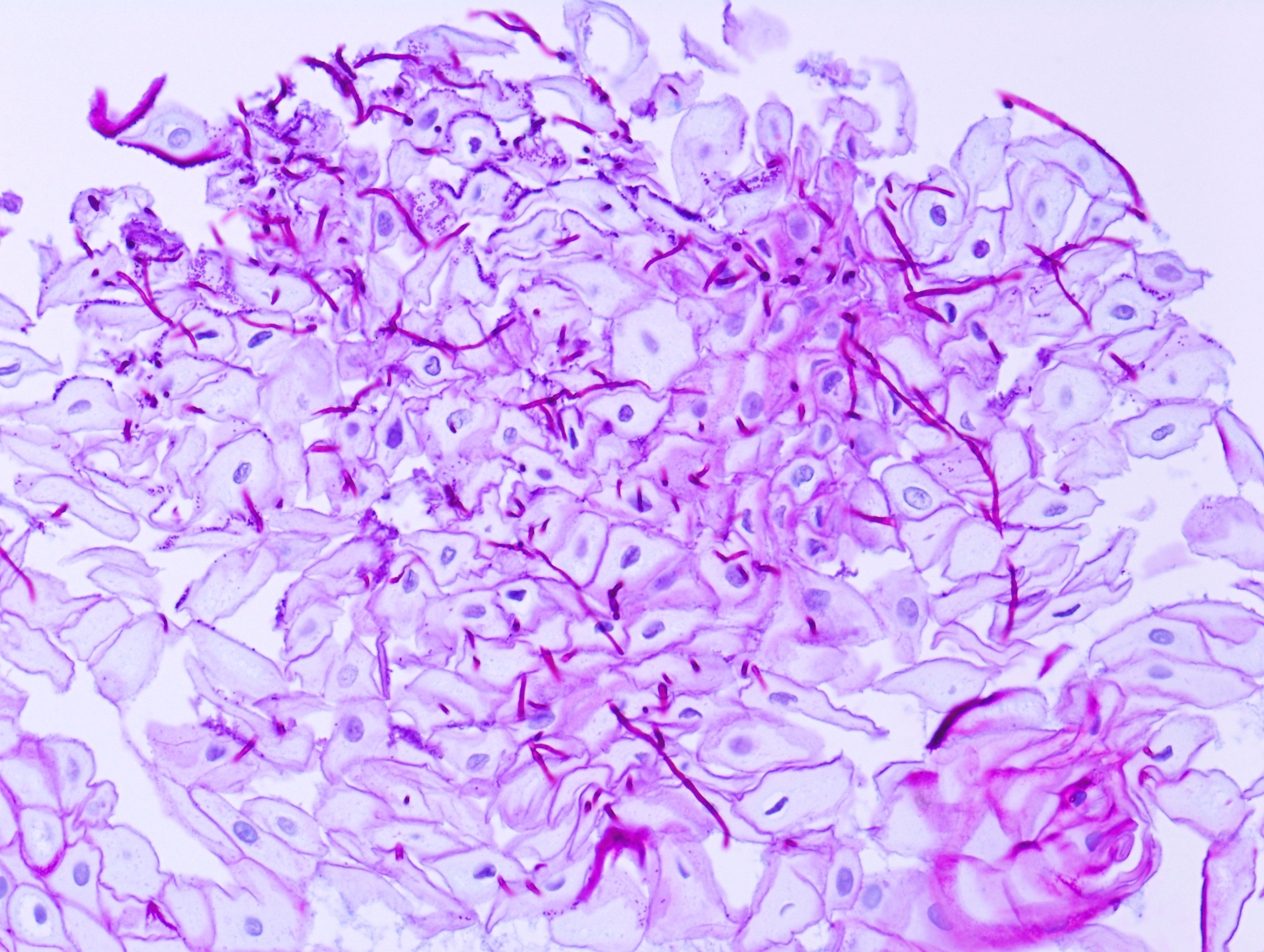 Periodic acid Schiff PAS stain glycogen magenta