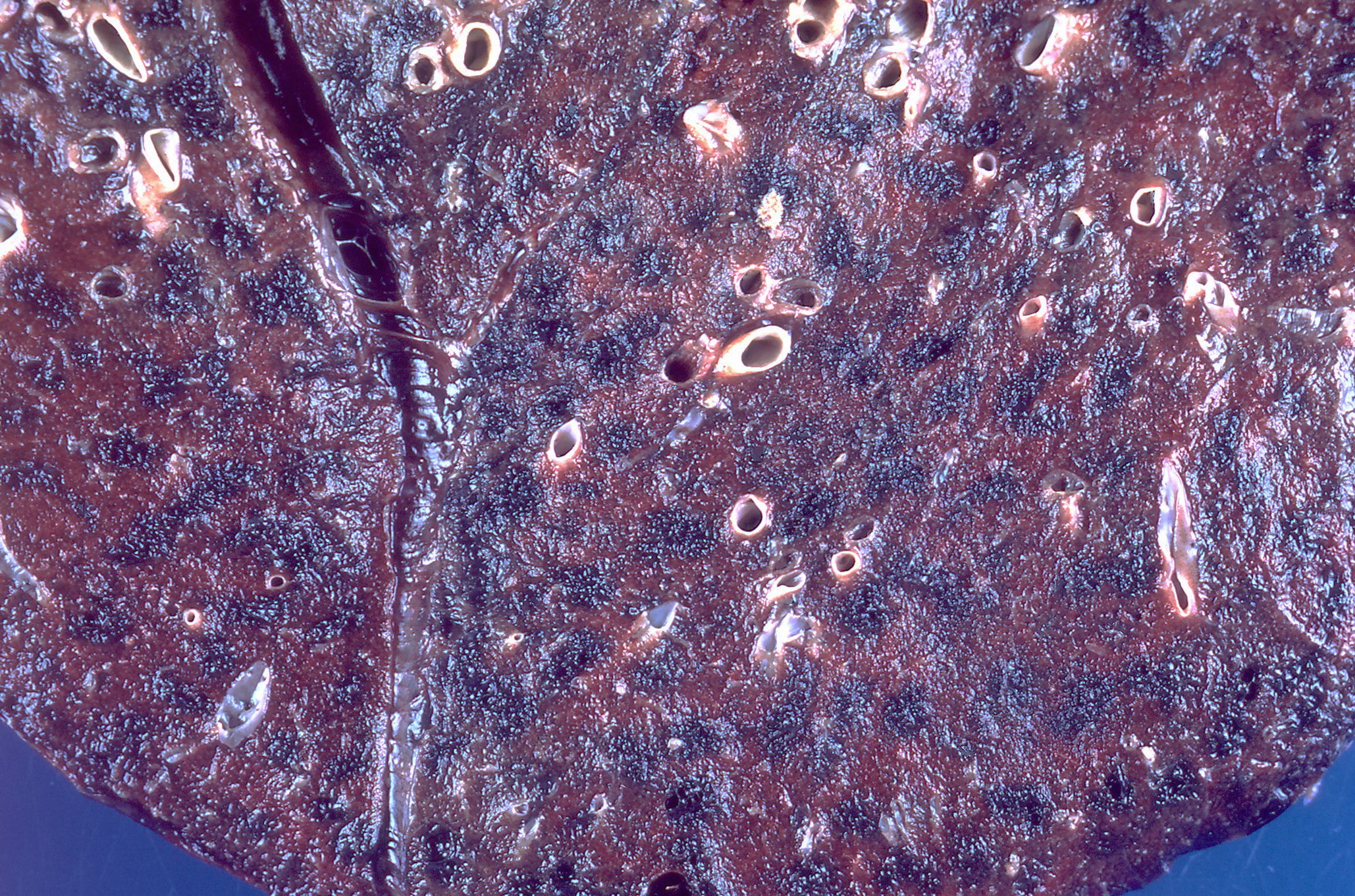 Anthracosis black carbon pigment lung macrophages