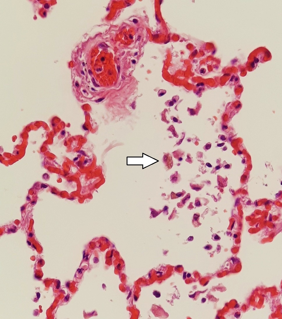Heart failure cells haemosiderin-laden macrophages in alveoli