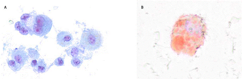 Lipid laden macrophages foamy vacuolated cytoplasm