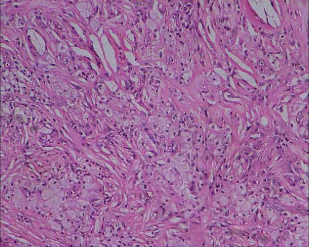 Foamy histiocytes vacuolated macrophages