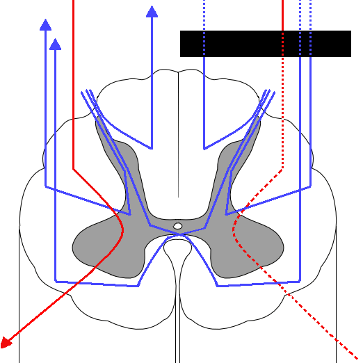 Spinal cord cross-section showing ascending dorsal column and crossed spinothalamic pathways