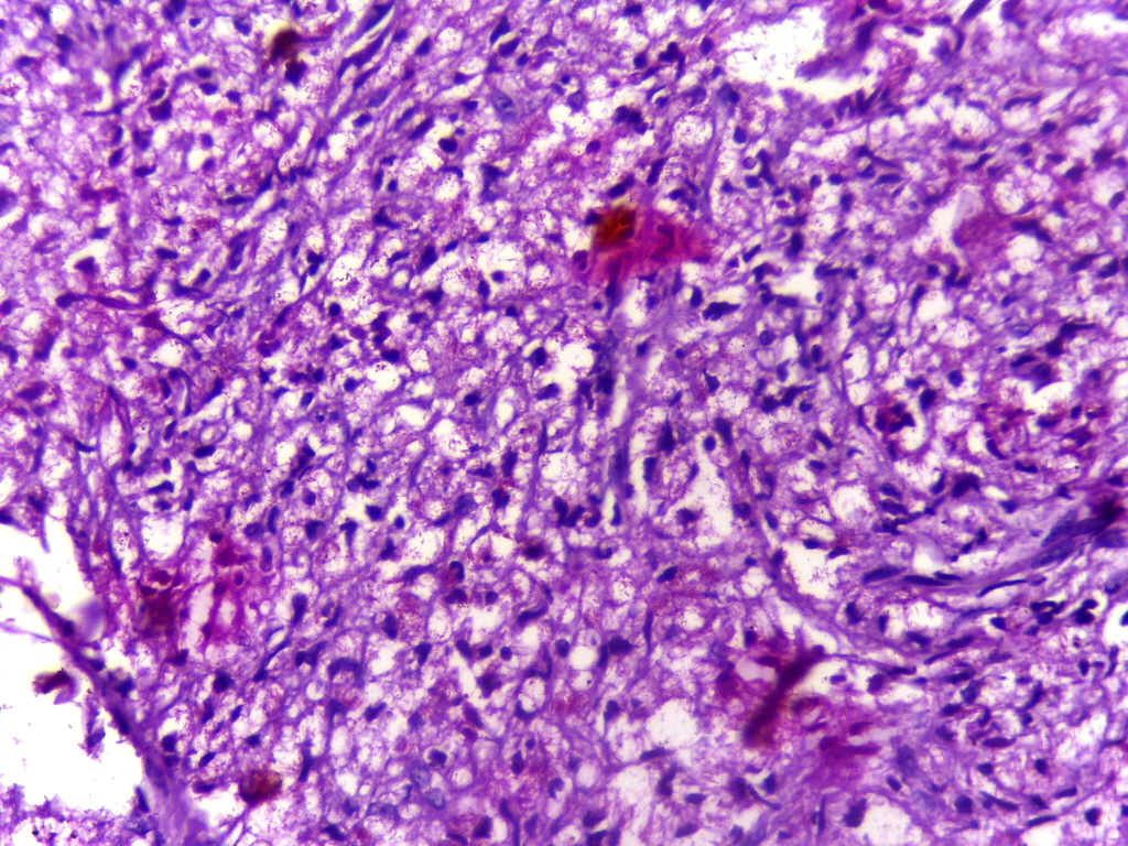 Lepromatous leprosy foamy macrophages
