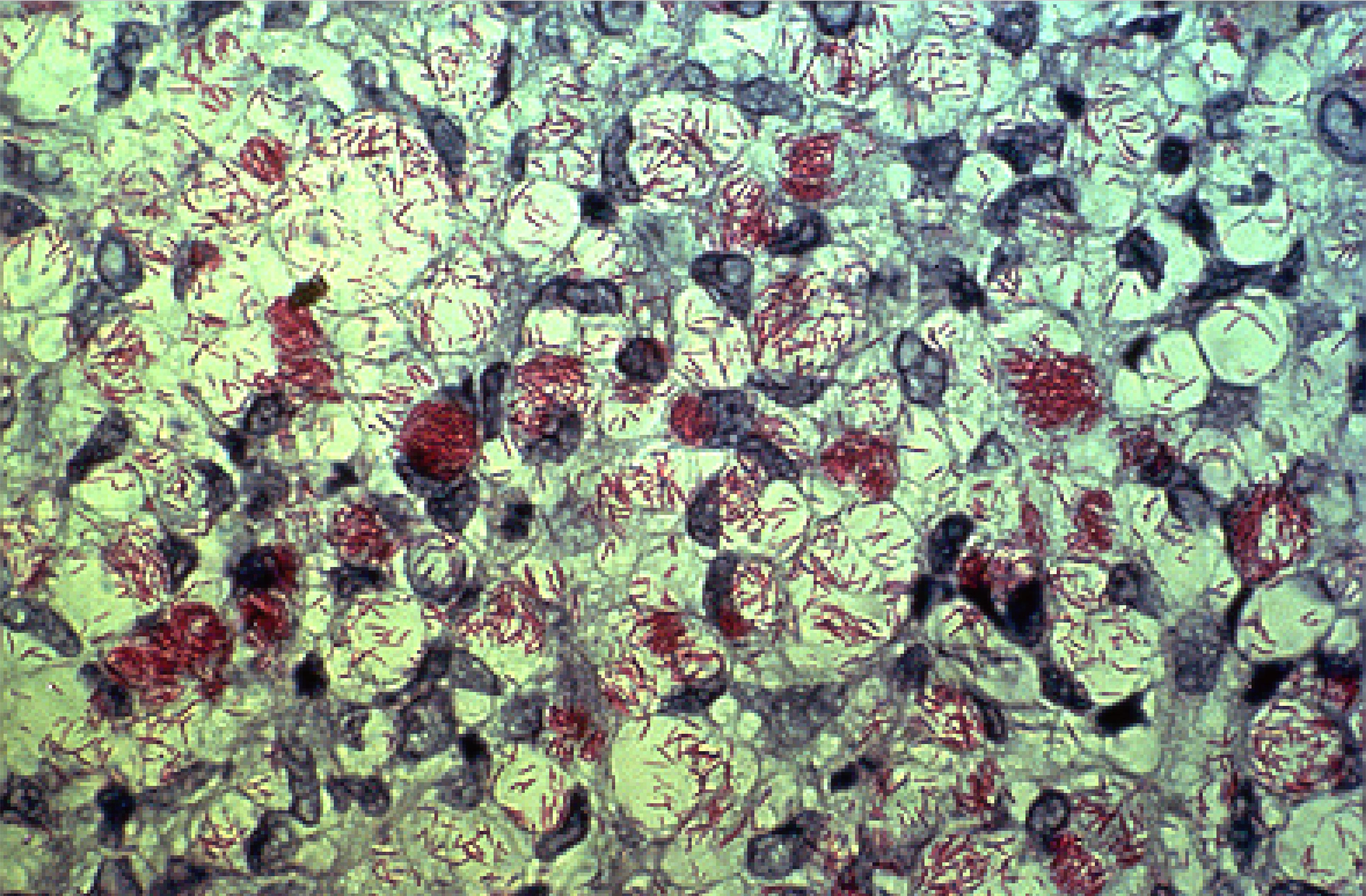 Acid-fast bacilli smear
