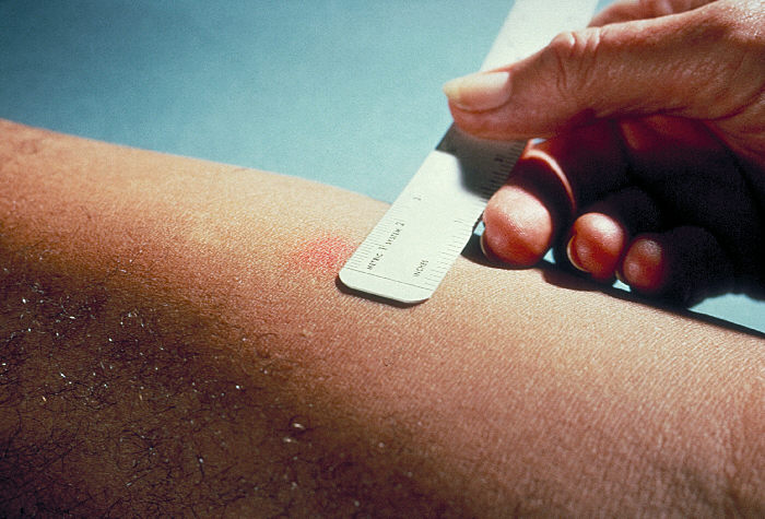 Delayed hypersensitivity skin test