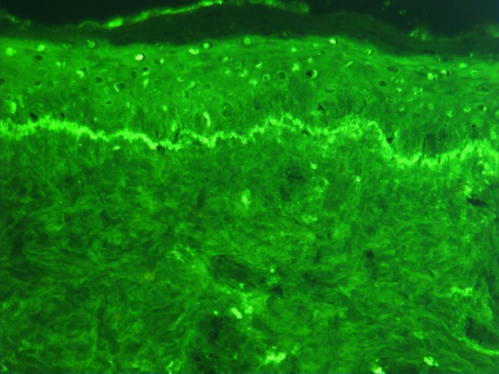 Immune complex immunofluorescence