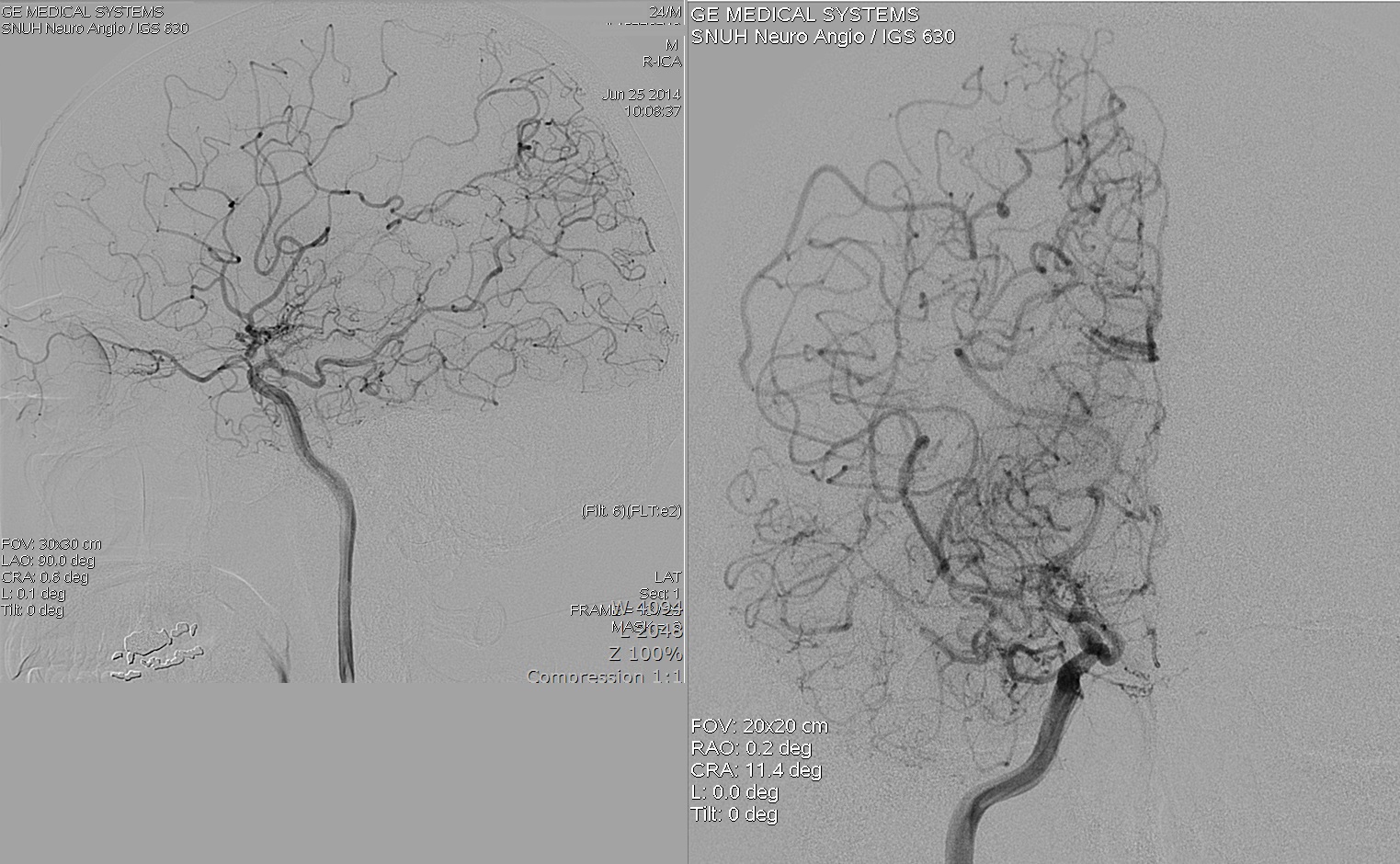 Internal carotid angiography