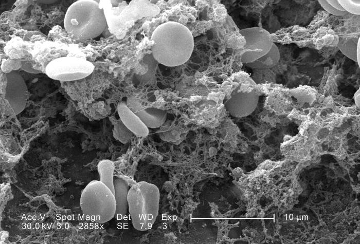 Fibrin clot mesh