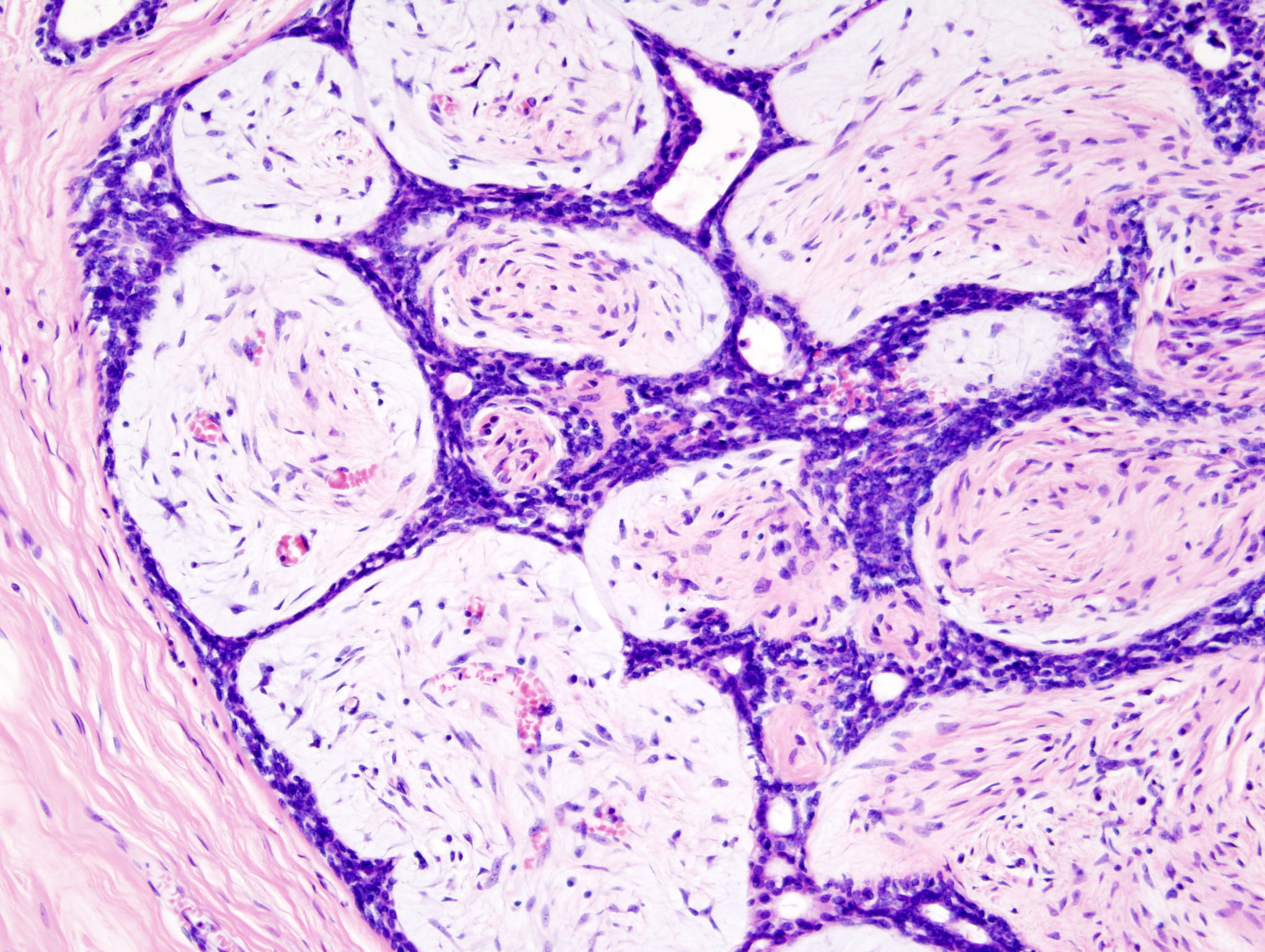 Encapsulated tumour for contrast