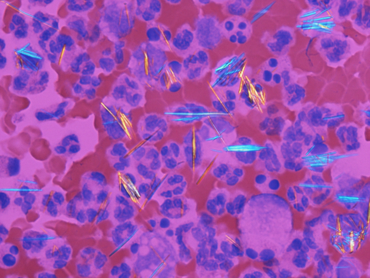 Needle-shaped monosodium urate crystals under polarised light