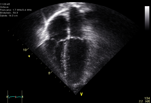 echocardiogram