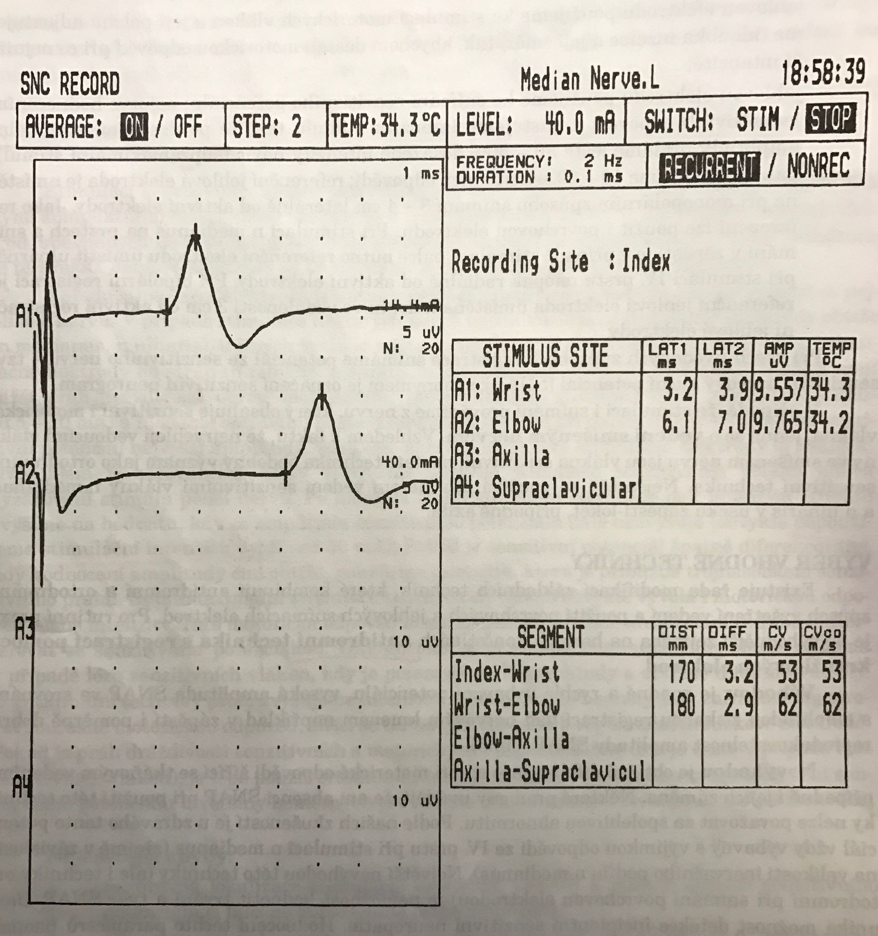 nerve conduction study