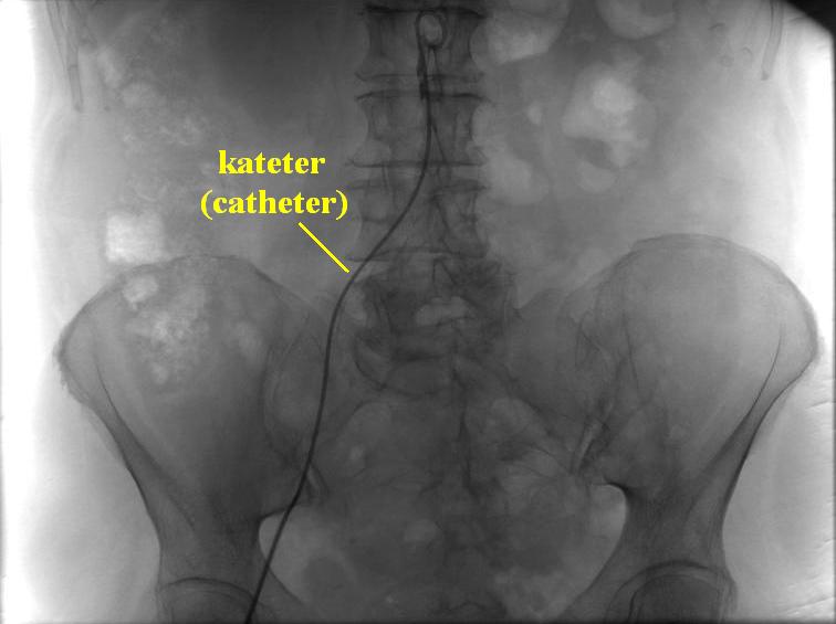 adrenal vein sampling catheter angiography